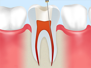 抜髄根管治療