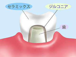 ジルコニアセラミック