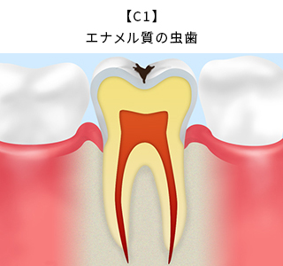 【C1】エナメル質の虫歯