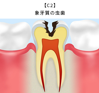 【C2】象牙質の虫歯