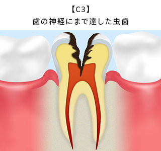 【C3】歯の神経にまで達した虫歯