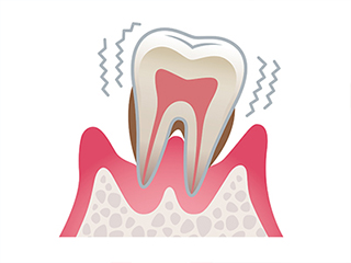 歯の動揺度検査