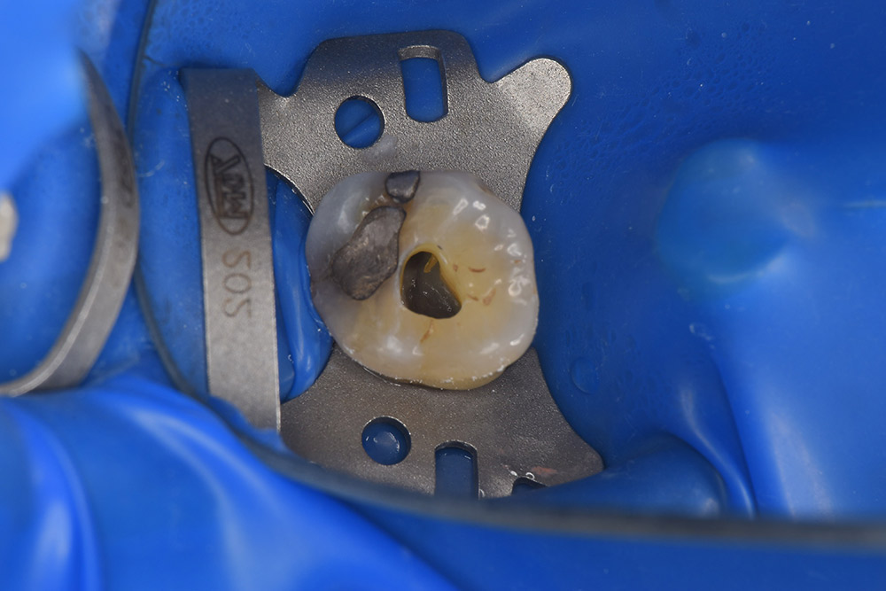 ラバーダム防湿による唾液中の細菌を防止